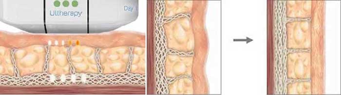 Cơ chế hoạt động của ultherapy