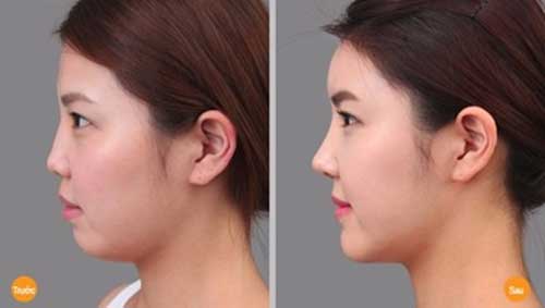 Kết quả giảm - xóa mỡ nọng cằm