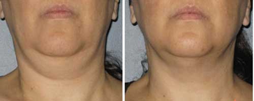 Kết quả giảm - xóa mỡ nọng cằm