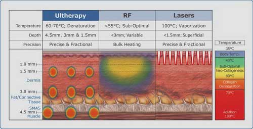 Khả năng nâng cơ của ultherapy