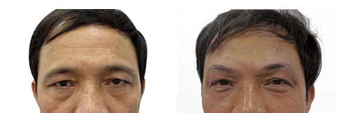 Kết quả nâng cung mày