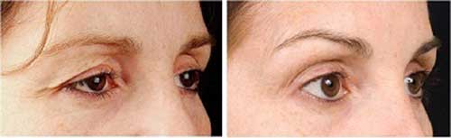 Kết quả nâng cung mày