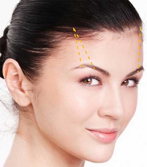 Nâng cung mày bằng chỉ Collagen