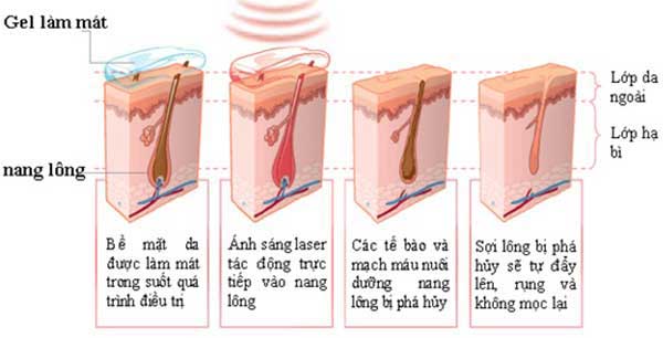 Quá trình triệt lông hiệu quả