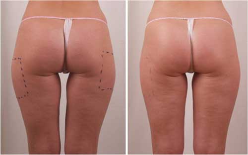 Săn chắc, thon gọn vùng mông đùi, chữa da sần ngấn mỡ