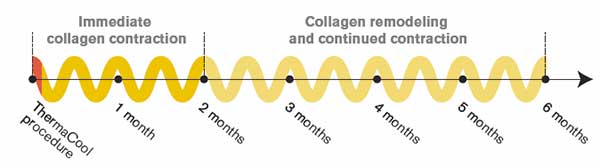 Sóng vô tuyến Thermage