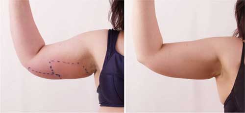 Thon gọn, tan mỡ bắp tay