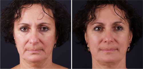 Trẻ hóa toàn gương mặt