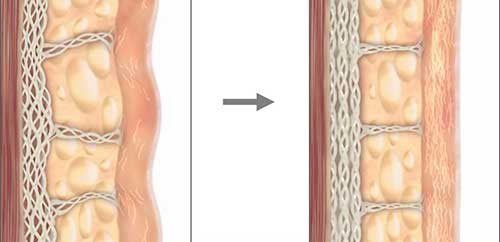ultherapy xóa nhăn, nâng cơ