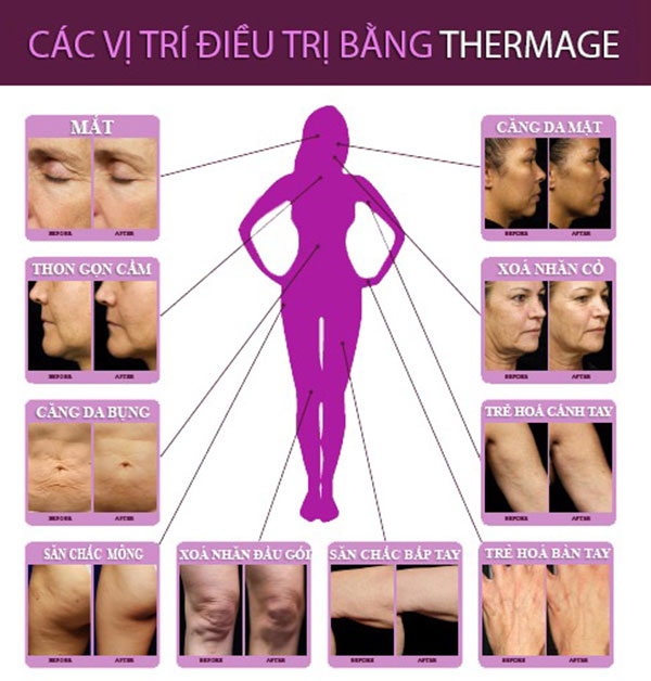 Các vị trí điều trị bằng Thermage