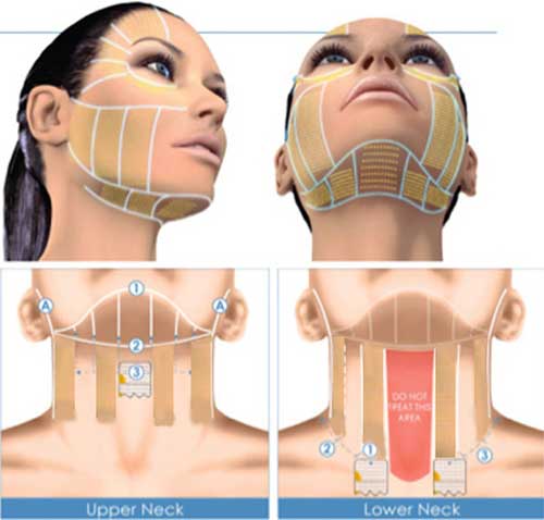 Vùng điều trị của ultherapy và thermage