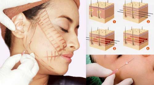 Cơ chế hoạt động của chỉ collagen trong da