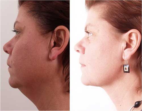 Xóa mỡ nọng cằm