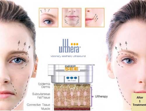 Ultherapy có tác dụng tạo mặt V-line