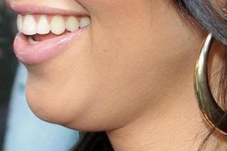 Phần nọng cằm to, chảy xệ là thủ phạm hàng đầu khiến bạn trông “dừ” trước tuổi