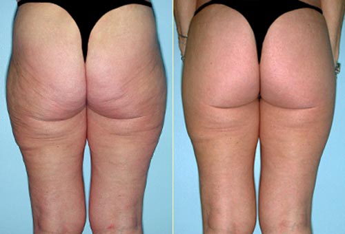 Kết quả nâng mông