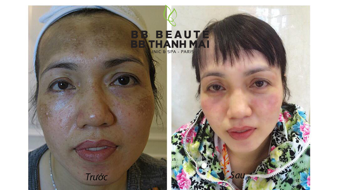 Trị nám tại BB-2