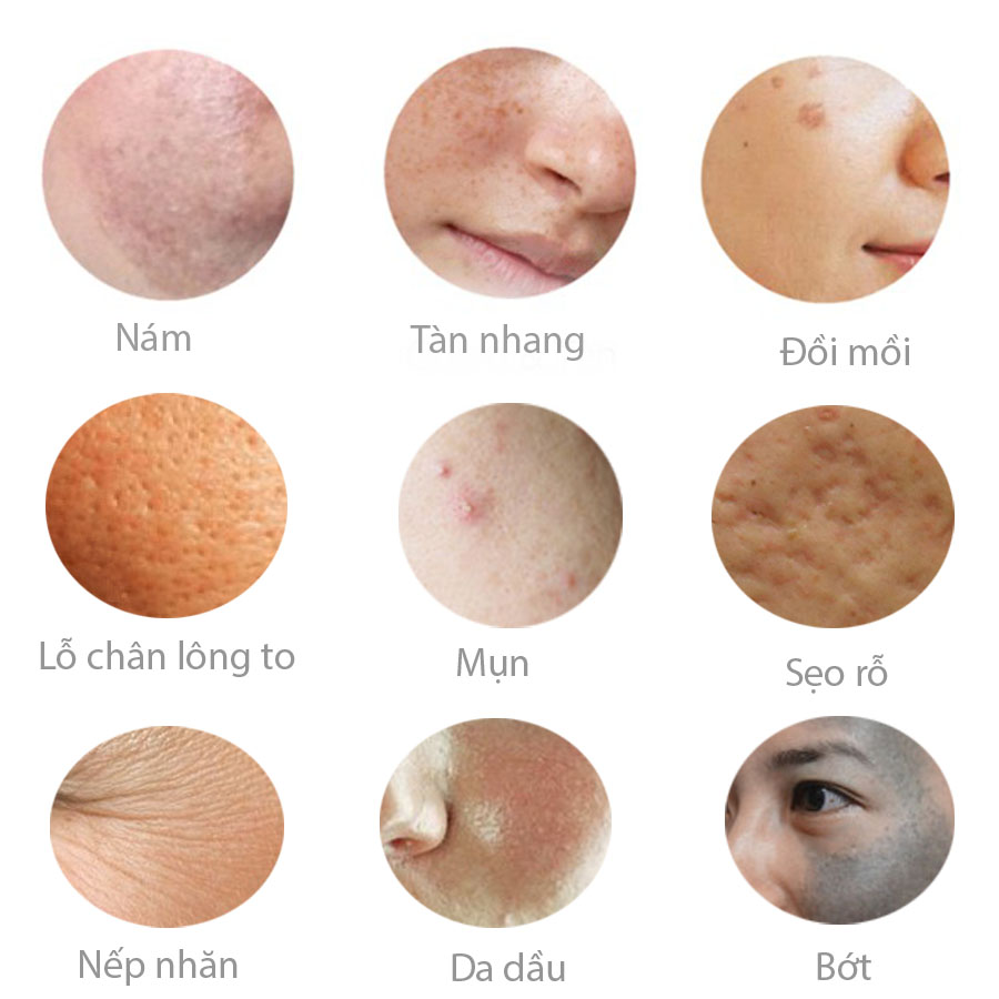 trị nám tại bb-3