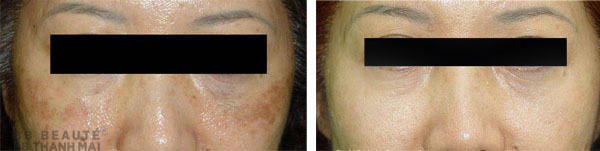 kết quả trị nám laser revlite