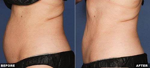 Kết quả giảm béo