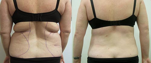 Kết quả giảm béo